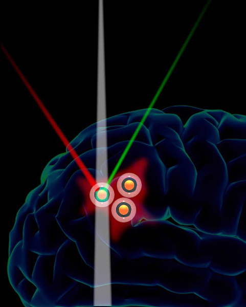 Researchers have created gold-core particles that gather around brain tumors (shown in red) an emit three different types of signals, which may lead to more precise, molecular-level imaging in the future. (Courtesy of Sam Gambhir)