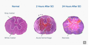 Stanford named center for spinal scaffold study