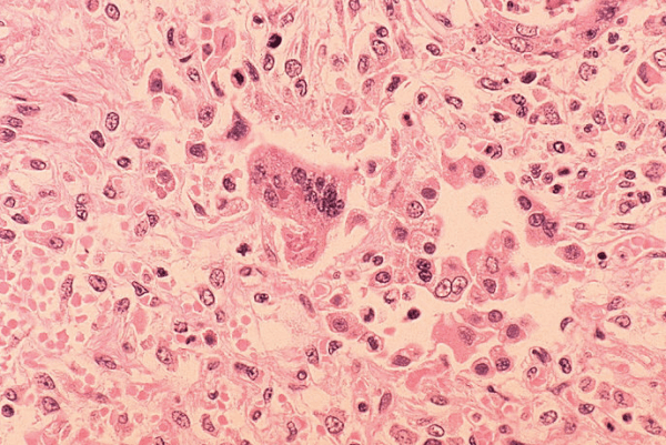 Stanford researchers find a five percent drop in measles vaccines would triple the number of infections in kids (Courtesy of CDC).